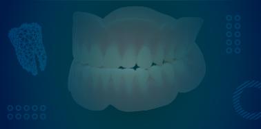 Full Denture, Composite teeth (upper or lower)